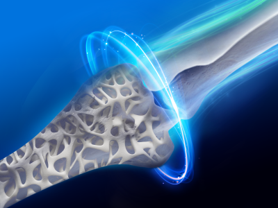 OsteoIQ™ Active Monitoring (CTX & P1NP)