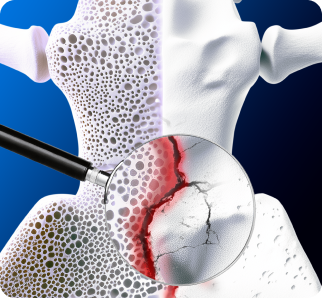 Active Bone Loss Test (CTX).